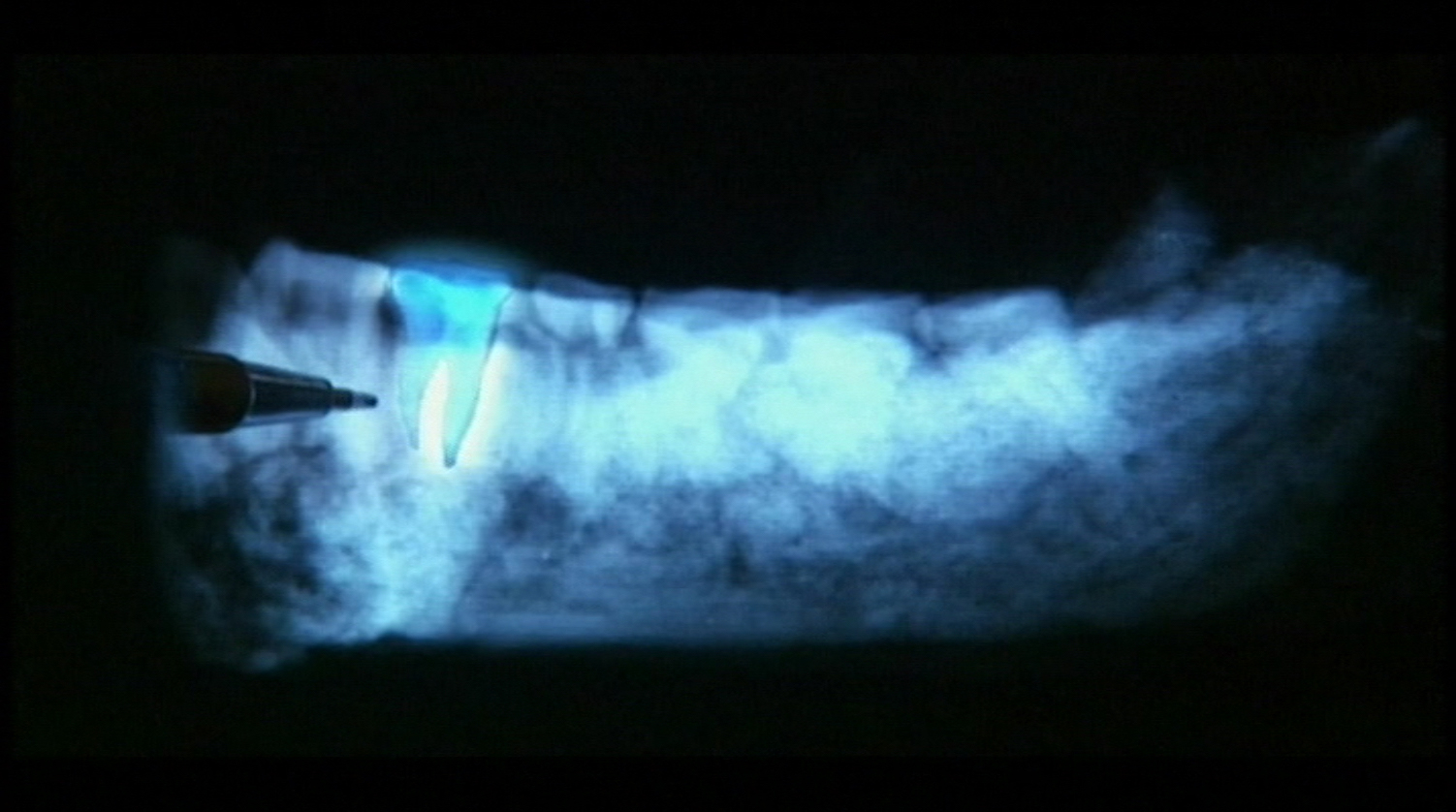 BBC Horizon LB6 Homo floresiensis x-ray root reconstruction